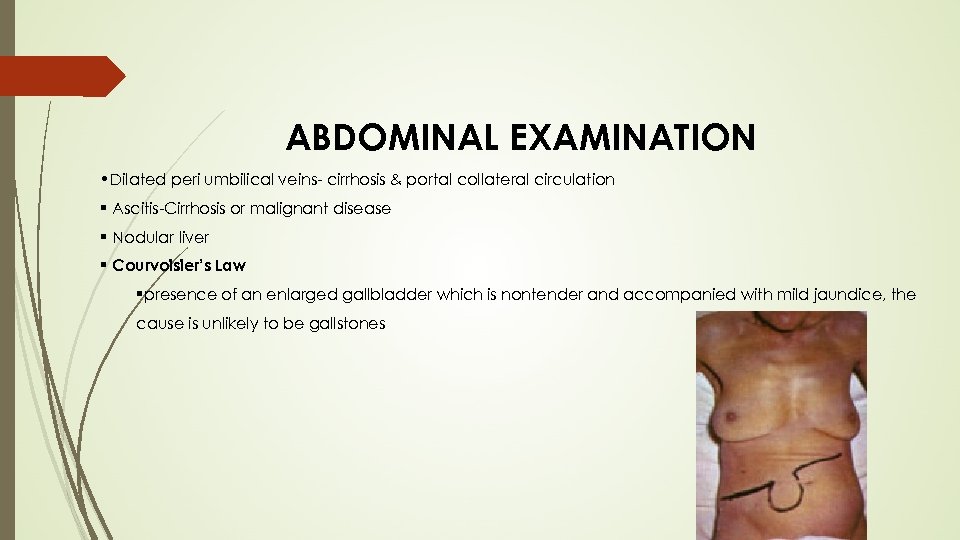 ABDOMINAL EXAMINATION • Dilated peri umbilical veins- cirrhosis & portal collateral circulation § Ascitis-Cirrhosis