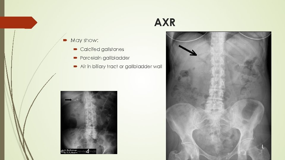 AXR May show: Calcifed gallstones Porcelain gallbladder Air in biliary tract or gallbladder wall