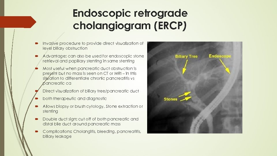 Endoscopic retrograde cholangiogram (ERCP) Invasive procedure to provide direct visualization of level biliary obstruction
