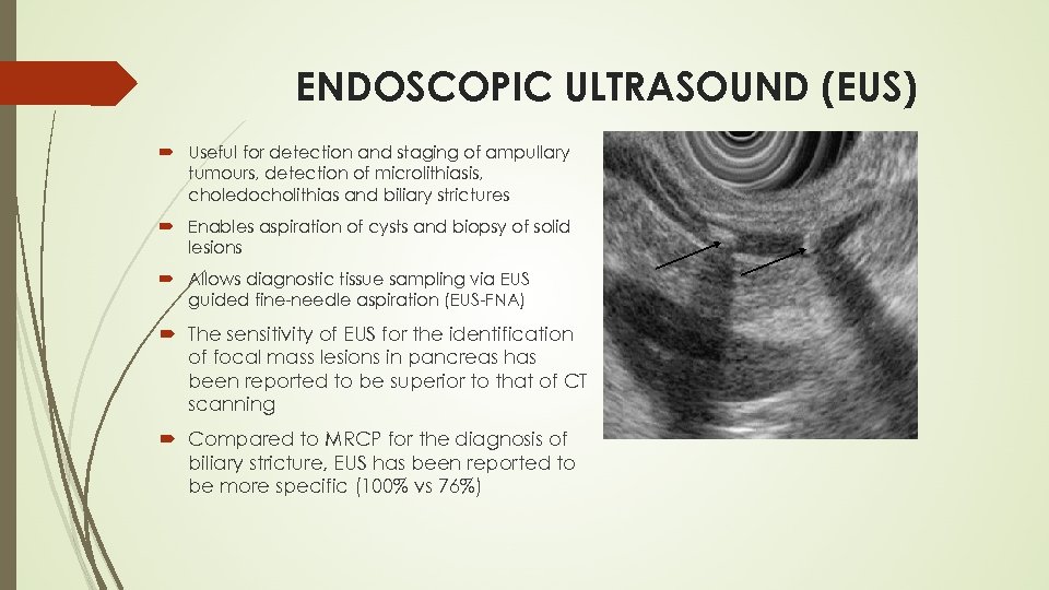 ENDOSCOPIC ULTRASOUND (EUS) Useful for detection and staging of ampullary tumours, detection of microlithiasis,