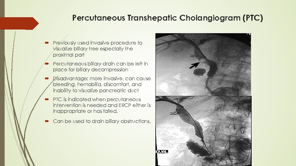 Percutaneous Transhepatic Cholangiogram (PTC) Previously used invasive procedure to visualize biliary tree especially the