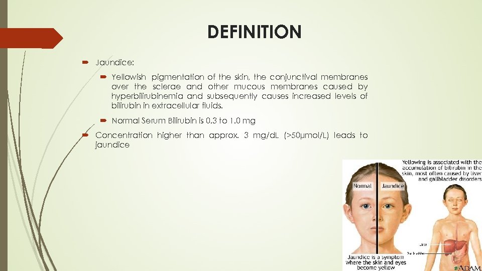 DEFINITION Jaundice: Yellowish pigmentation of the skin, the conjunctival membranes over the sclerae and