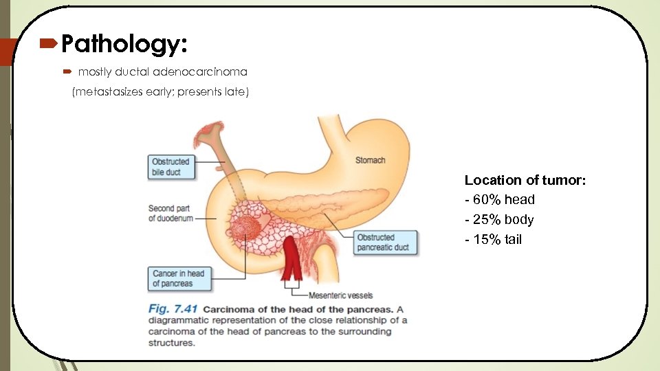  Pathology: mostly ductal adenocarcinoma (metastasizes early; presents late) Location of tumor: - 60%