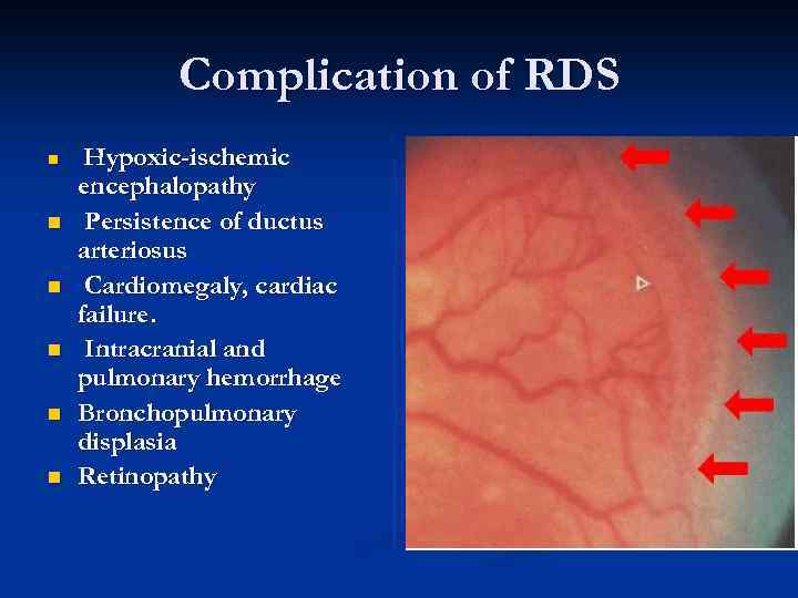 Complication of RDS n n n Hypoxic-ischemic encephalopathy Persistence of ductus arteriosus Cardiomegaly, cardiac