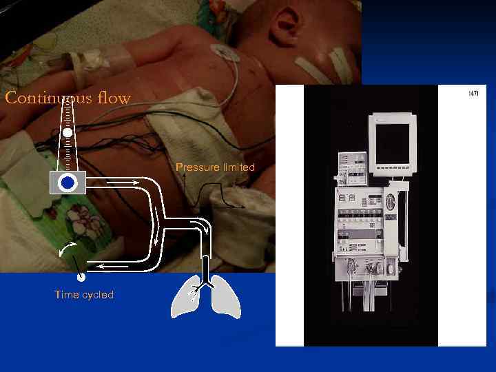 Continuous flow Pressure limited Time cycled 