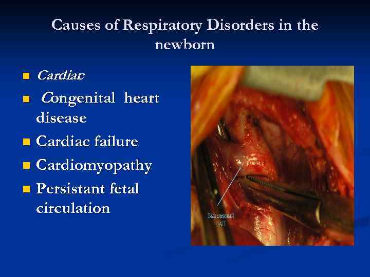 Causes of Respiratory Disorders in the newborn n n Cardiac : Congenital heart disease