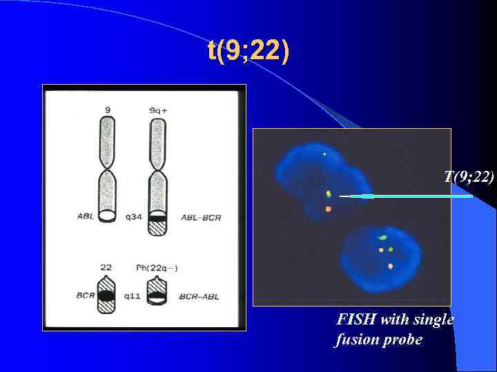 t(9; 22) T(9; 22) FISH with single fusion probe 