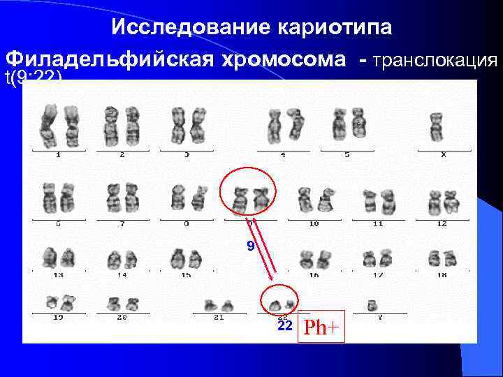 Исследование кариотипа Филадельфийская хромосома - транслокация t(9; 22) 9 22 Ph+ 