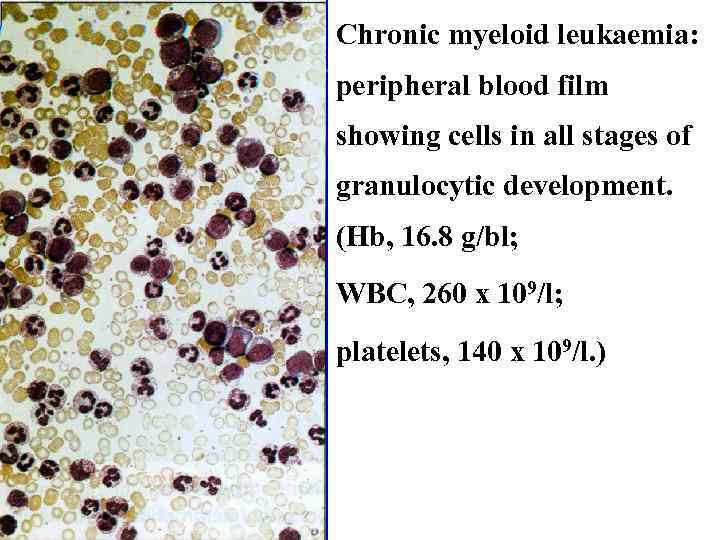 Chronic myeloid leukaemia: peripheral blood film showing cells in all stages of granulocytic development.