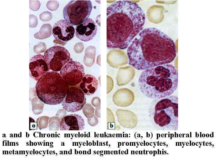 a and b Chronic myeloid leukaemia: (a, b) peripheral blood films showing a myeloblast,