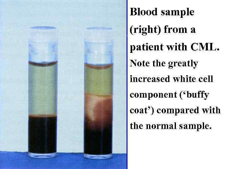 Blood sample (right) from a patient with CML. Note the greatly increased white cell