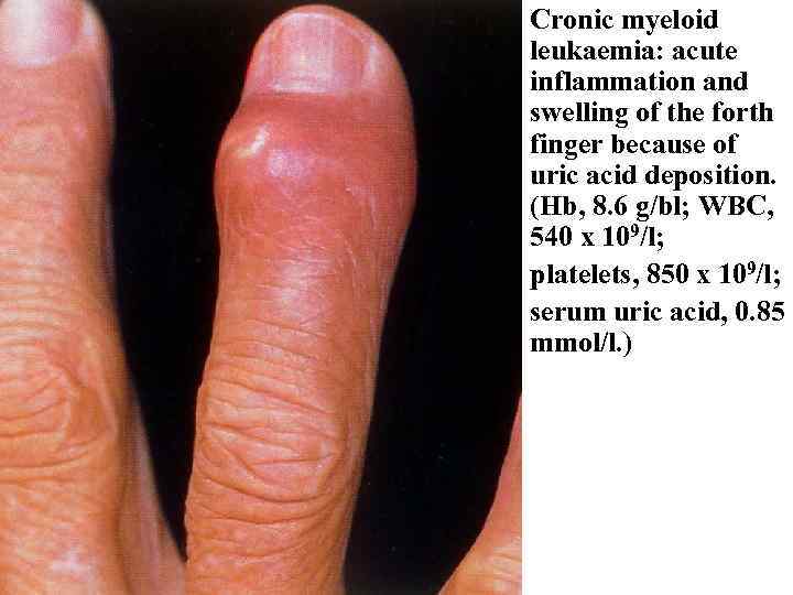 Cronic myeloid leukaemia: acute inflammation and swelling of the forth finger because of uric