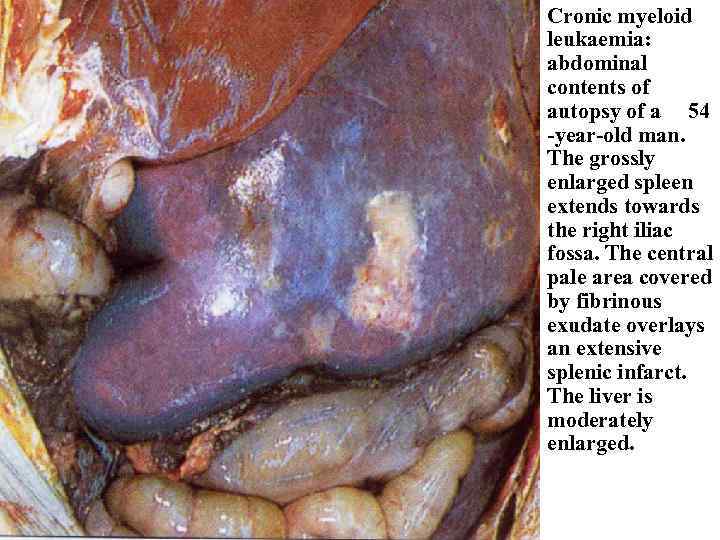 Cronic myeloid leukaemia: abdominal contents of autopsy of a 54 -year-old man. The grossly