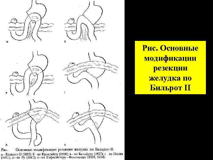 Операции по бильрот 1 и 2 схема