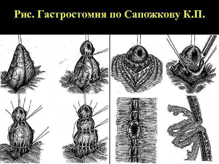 Рис. Гастростомия по Сапожкову К. П. 