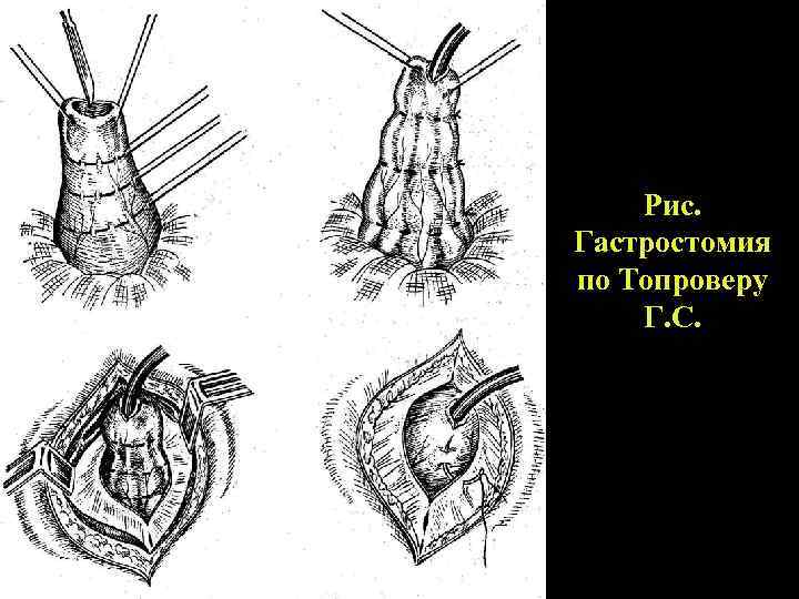 Рис. Гастростомия по Топроверу Г. С. 