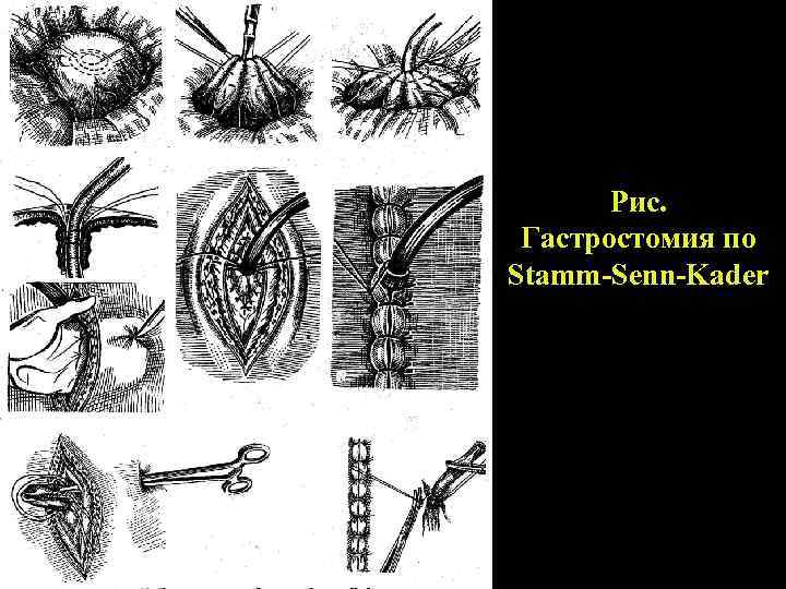 Рис. Гастростомия по Stamm-Senn-Kader 