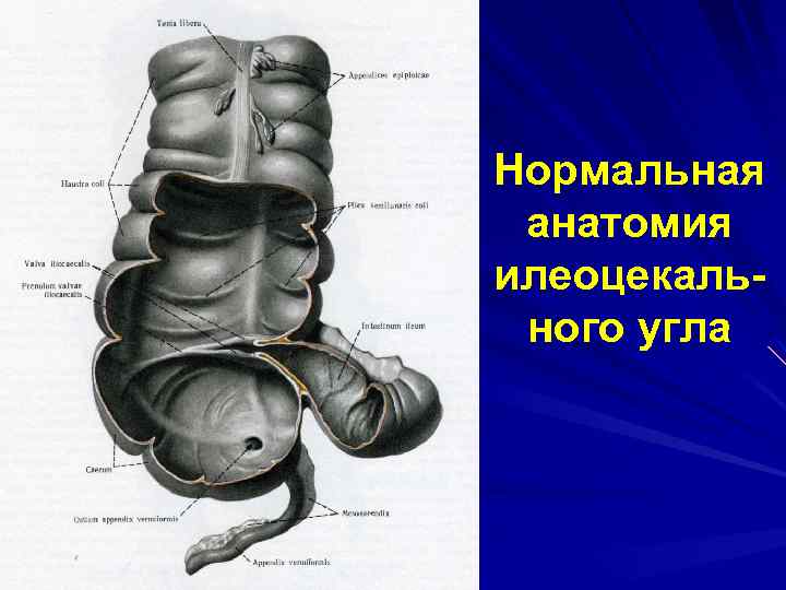 Илеоцекальный клапан где находится у человека фото