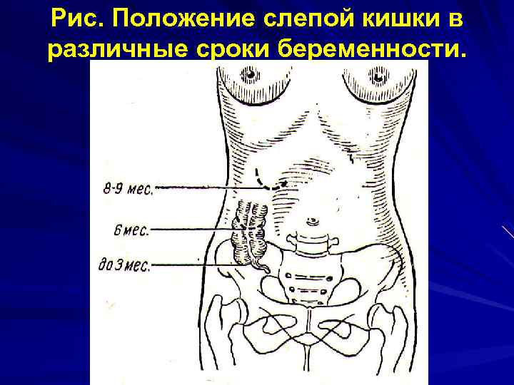 Рис. Положение слепой кишки в различные сроки беременности. 