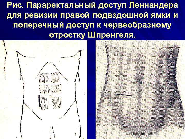 Рис. Параректальный доступ Леннандера для ревизии правой подвздошной ямки и поперечный доступ к червеобразному