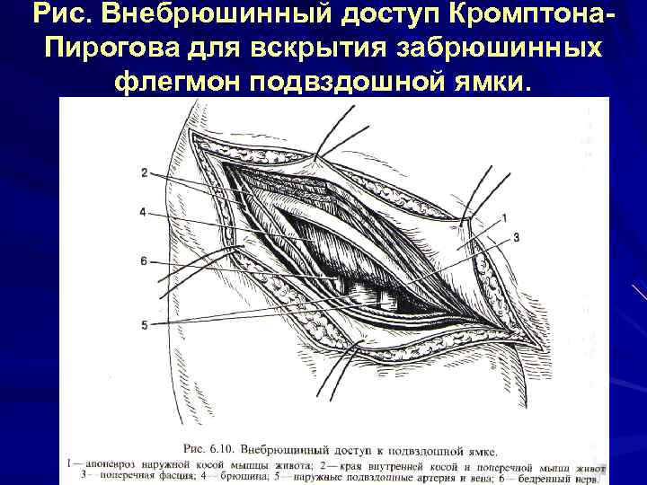 Рис. Внебрюшинный доступ Кромптона. Пирогова для вскрытия забрюшинных флегмон подвздошной ямки. 