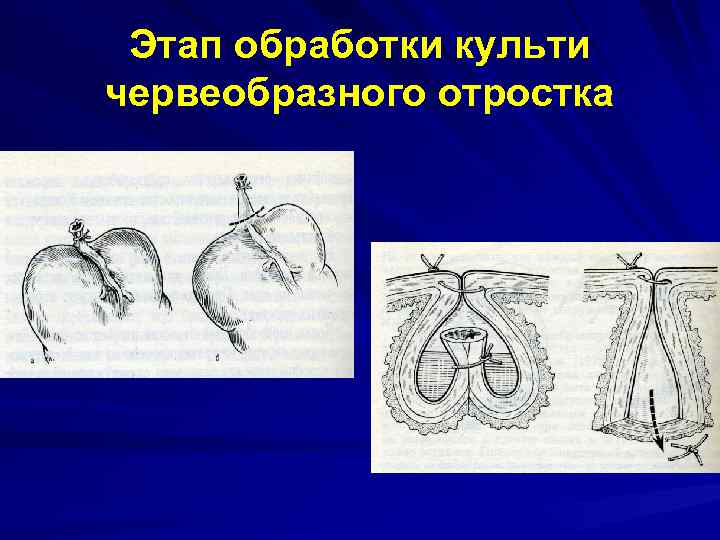 Этап обработки культи червеобразного отростка 