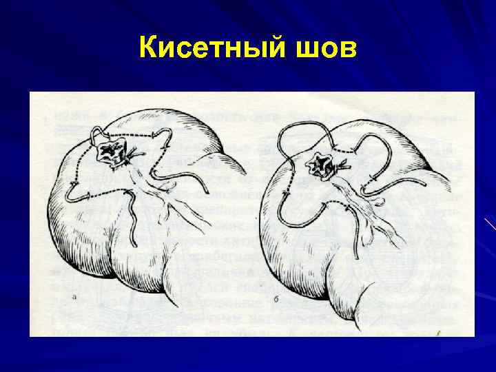 Кисетный шов 