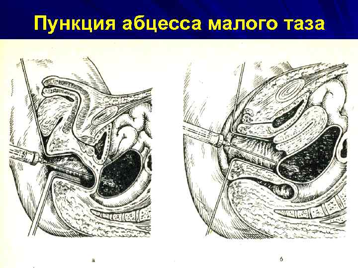 Пункция абцесса малого таза 