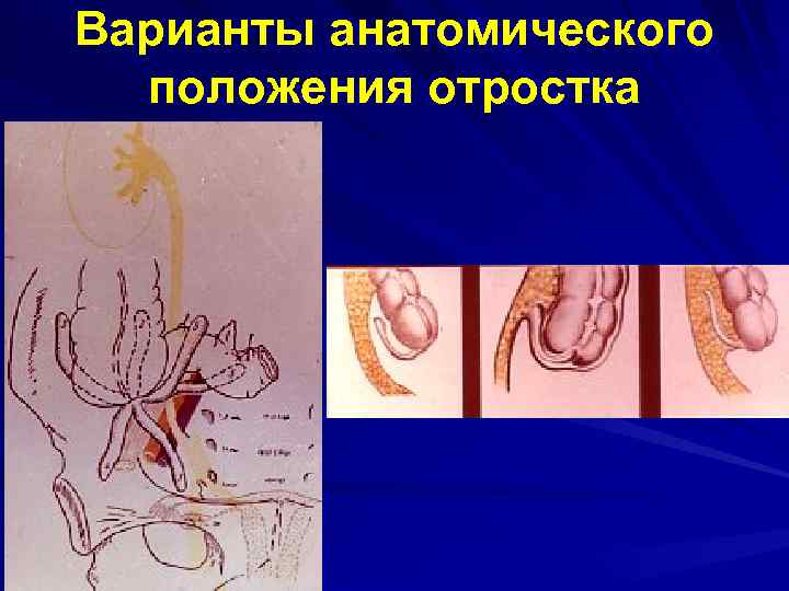 Варианты анатомического положения отростка 