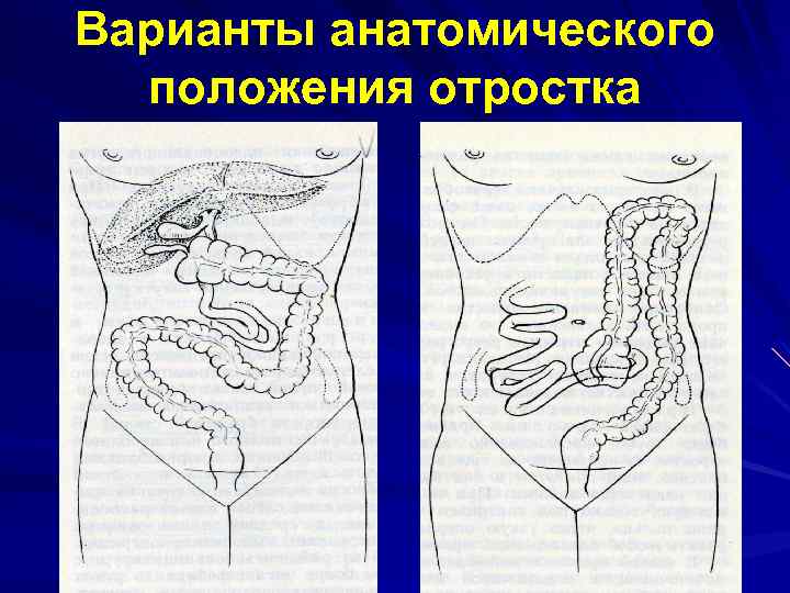 Варианты анатомического положения отростка 