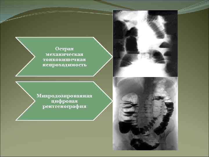 Острая механическая тонкокишечная непроходимость Микродозированная цифровая рентгенография 