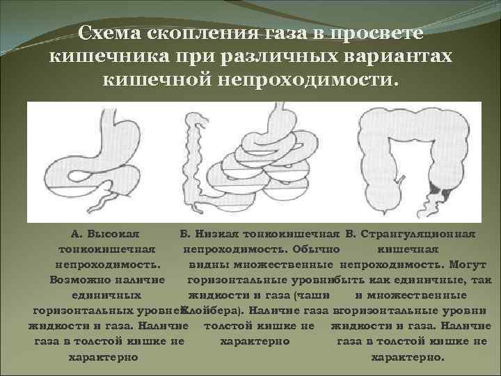 Схема скопления газа в просвете кишечника при различных вариантах кишечной непроходимости. А. Высокая Б.