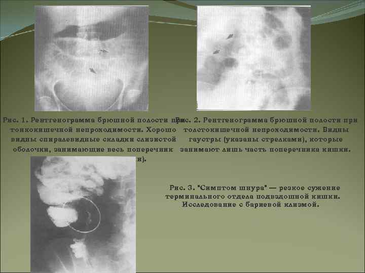 Рис. 1. Рентгенограмма брюшной полости при 2. Рентгенограмма брюшной полости при Рис. тонкокишечной непроходимости.