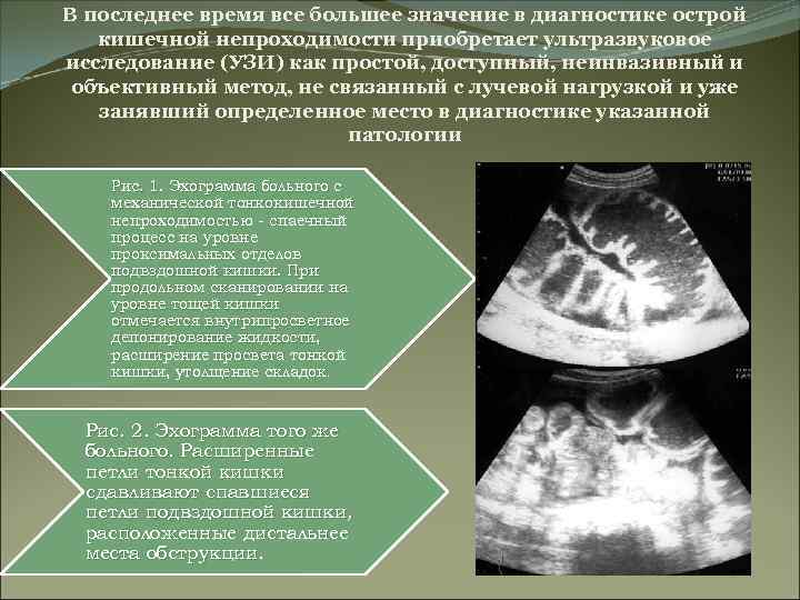 Клиническая картина острой обтурационной толстокишечной непроходимости характеризуется