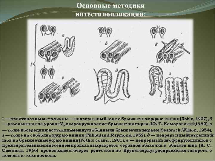 Основные методики интестинопликации: I — пристеночные методики: — непрерывный а шов по брыжеечному краю