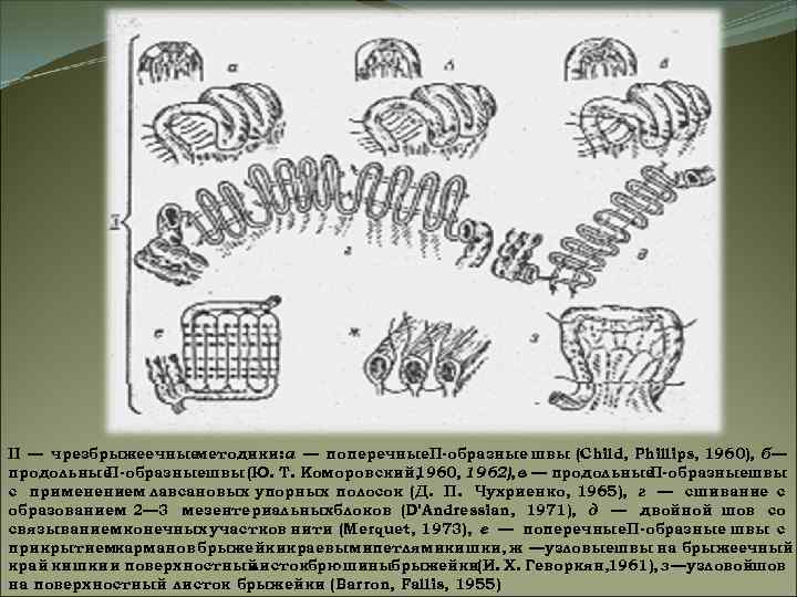 II — чрезбрыжеечные методики: а — поперечные. П-образные швы (Child, Phillips, 1960), б— продольные