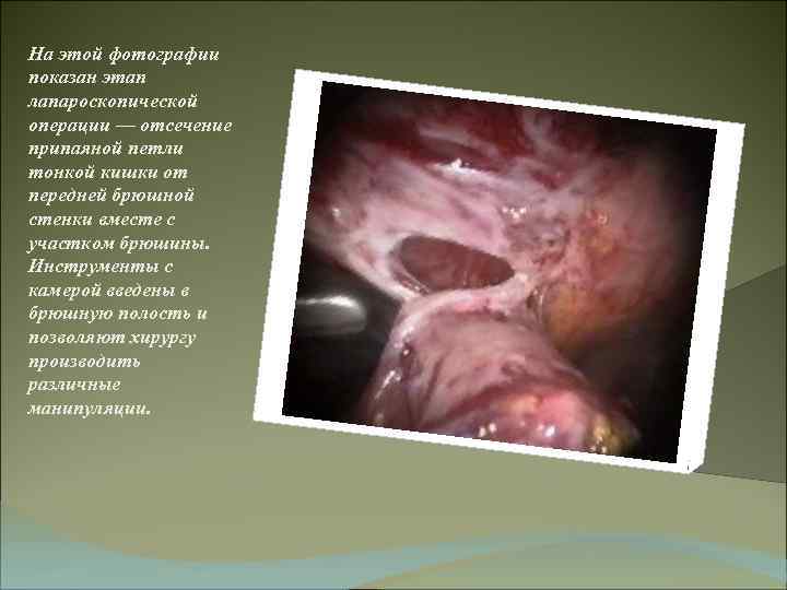 На этой фотографии показан этап лапароскопической операции — отсечение припаяной петли тонкой кишки от