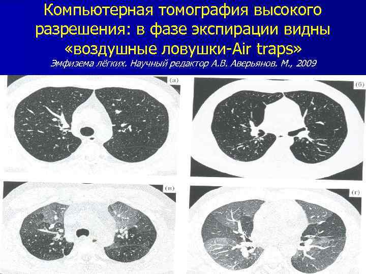 Компьютерная томография высокого разрешения: в фазе экспирации видны «воздушные ловушки-Air traps» Эмфизема лёгких. Научный