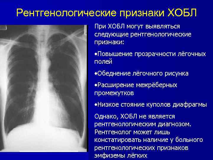 Рентгенологические признаки ХОБЛ При ХОБЛ могут выявляться следующие рентгенологические признаки: • Повышение прозрачности лёгочных