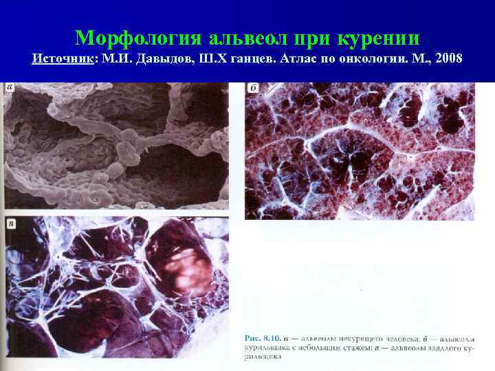 Морфология альвеол при курении Источник: М. И. Давыдов, Ш. Х ганцев. Атлас по онкологии.