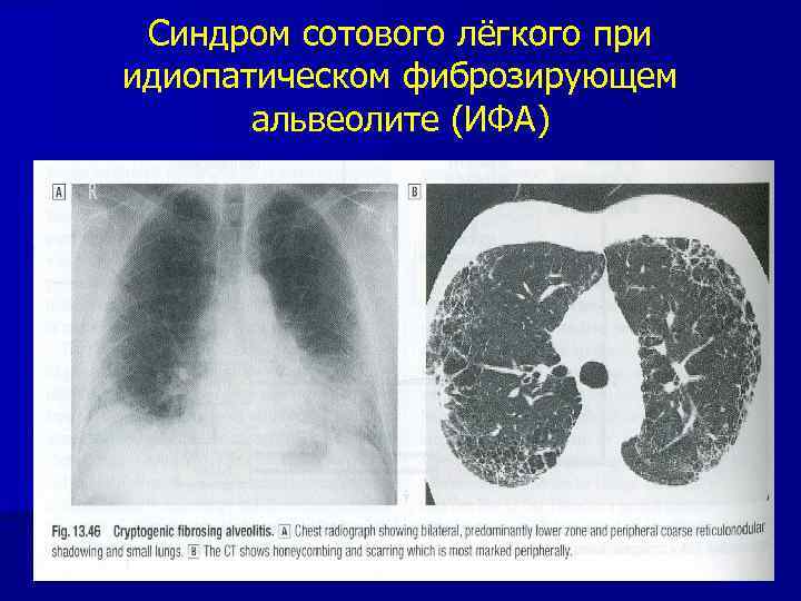 Синдром сотового лёгкого при идиопатическом фиброзирующем альвеолите (ИФА) 