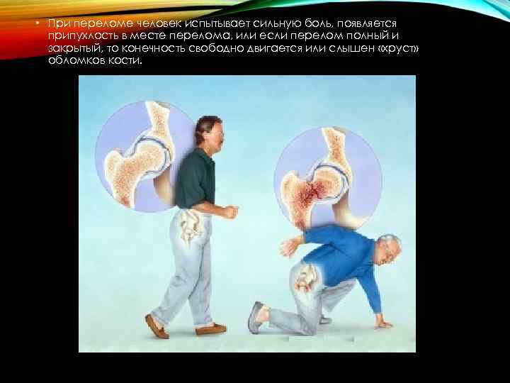  • При переломе человек испытывает сильную боль, появляется припухлость в месте перелома, или