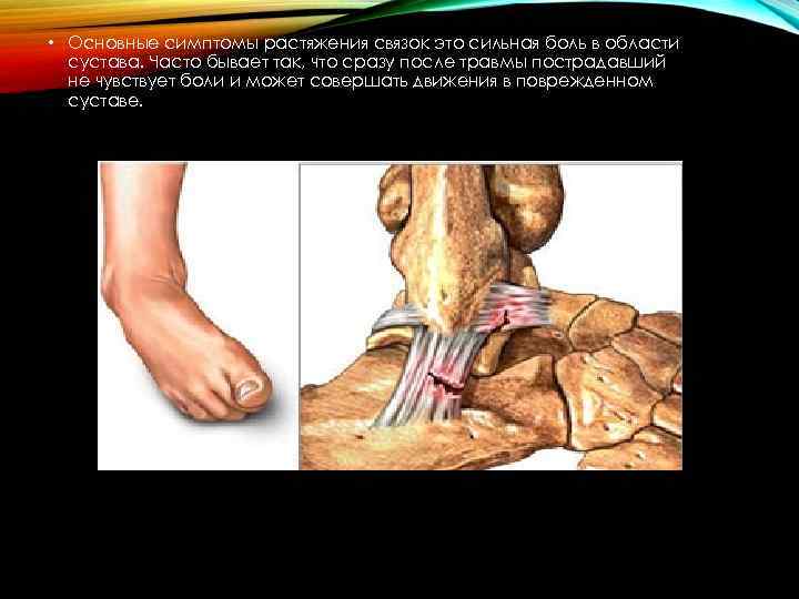  • Основные симптомы растяжения связок это сильная боль в области сустава. Часто бывает