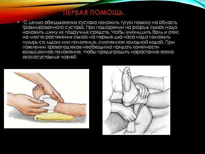 ПЕРВАЯ ПОМОЩЬ. • С целью обездвижения сустава наложить тугую повязку на область травмированного сустава.