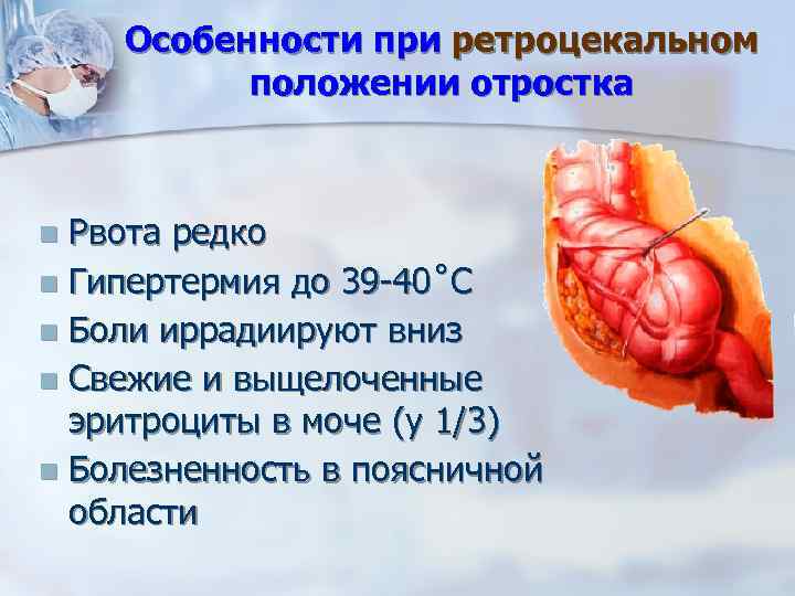 Особенности при ретроцекальном положении отростка Рвота редко n Гипертермия до 39 -40˚С n Боли