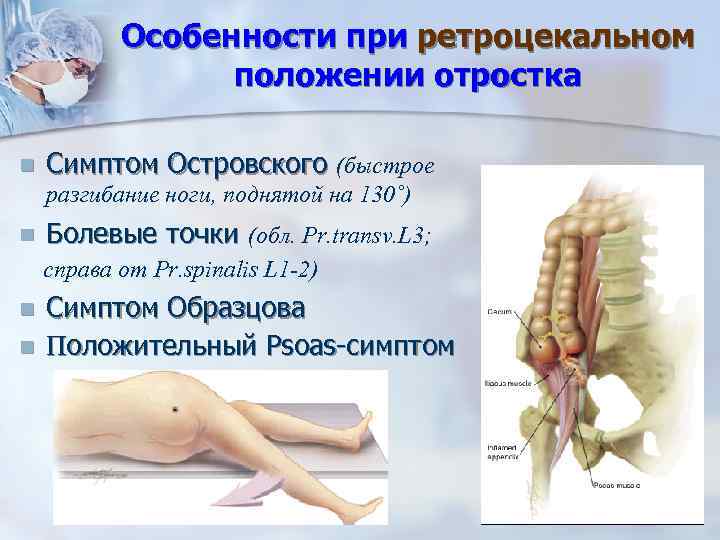 Особенности при ретроцекальном положении отростка n Симптом Островского (быстрое разгибание ноги, поднятой на 130˚)