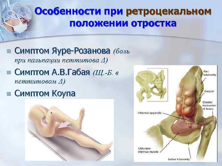 Особенности при ретроцекальном положении отростка n Симптом Яуре-Розанова (боль при пальпации петтитова Δ) n