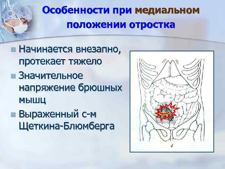 Особенности при медиальном положении отростка Начинается внезапно, протекает тяжело n Значительное напряжение брюшных мышц