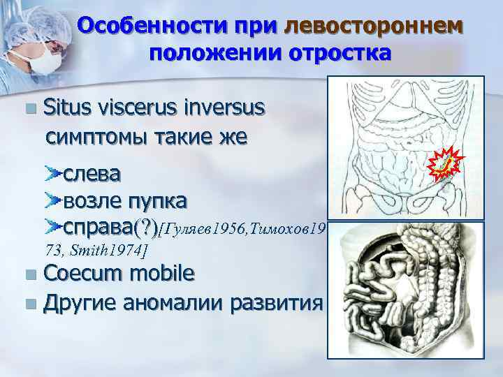 Особенности при левостороннем положении отростка n Situs viscerus inversus симптомы такие же слева возле