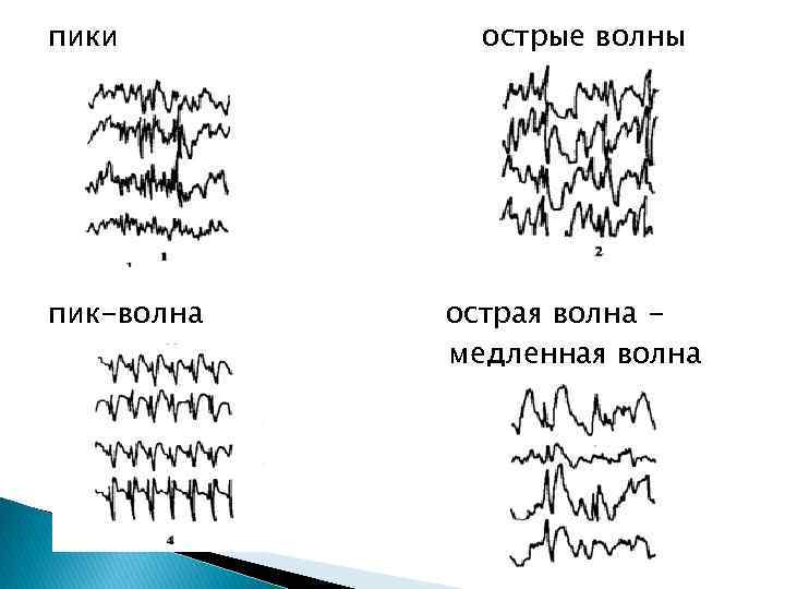 Комплекс медленных волн ээг. Комплекс острая медленная волна на ЭЭГ. Пик волна на ЭЭГ.